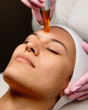 huidverbetering amsterdam - microneedling